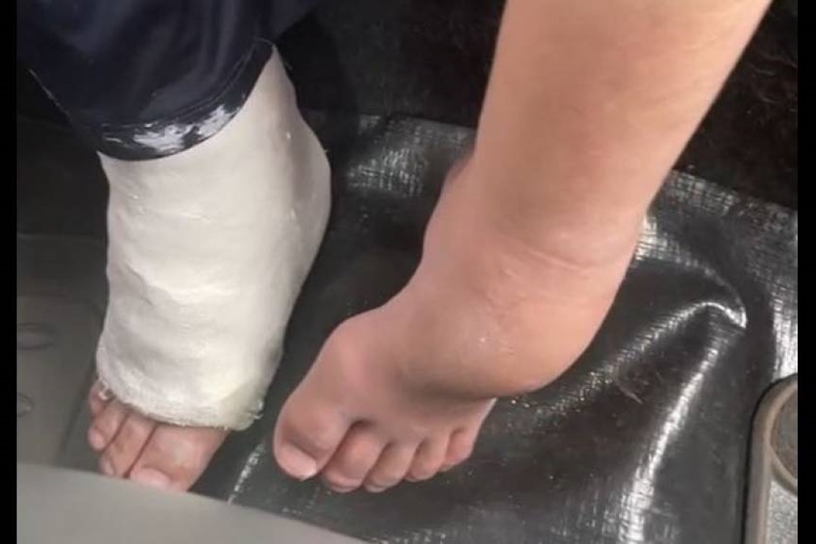 VÍDEO: Menino autista de 12 anos tem pé engessado por engano em Vilhena