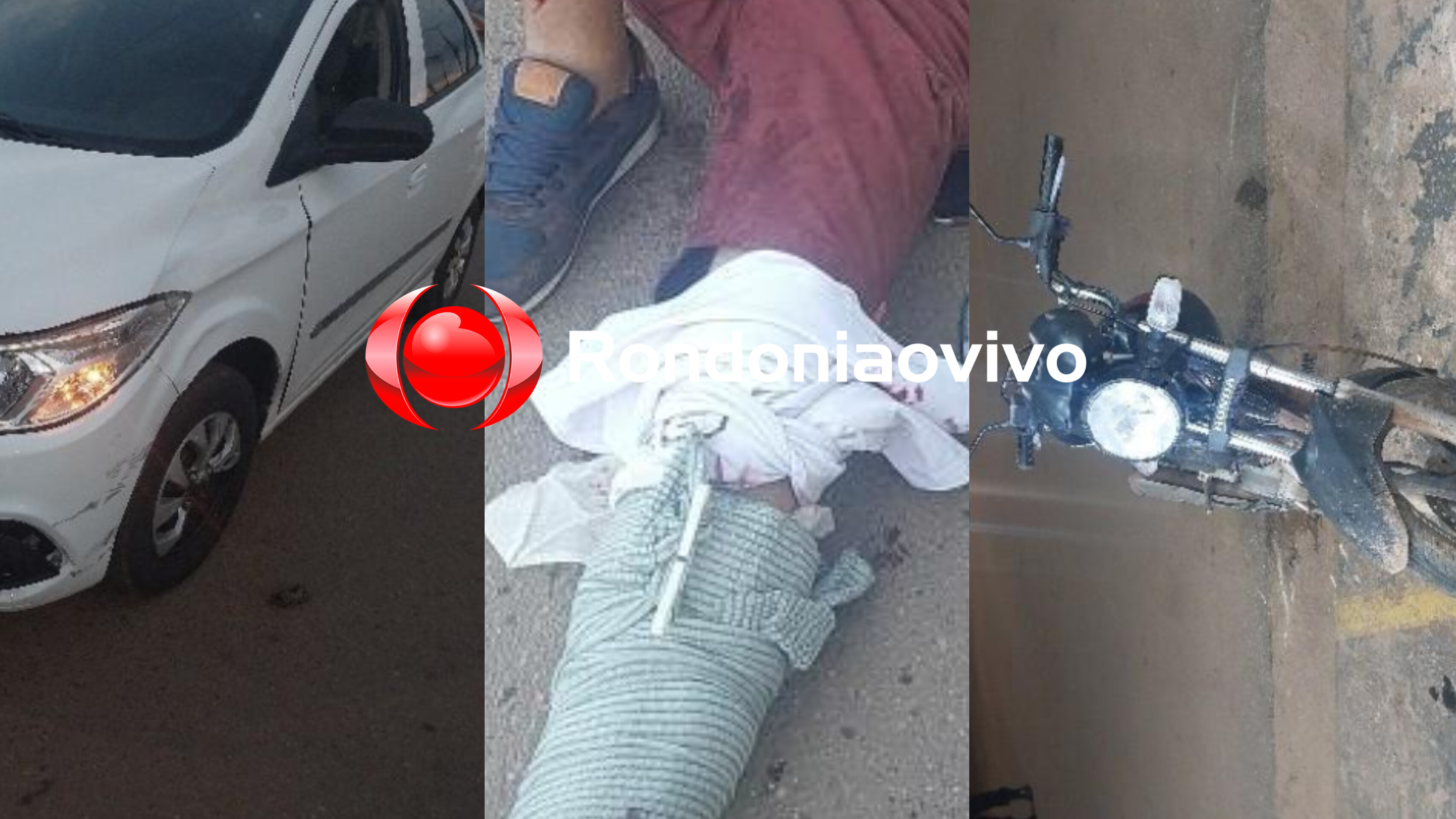 NA PAU FERRO: Motociclista tem fratura exposta na perna em gravíssimo acidente 