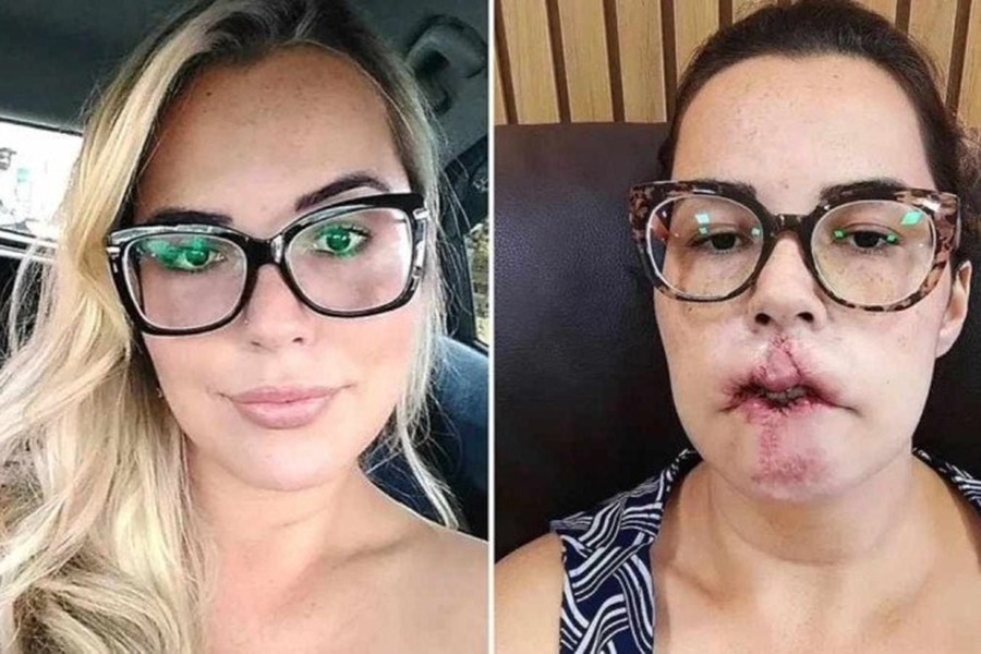 DRAMA: Mulher perde o lábio após fazer preenchimento com produto errado