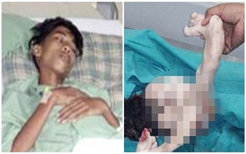 Adolescente passa por cirurgia para remover irmão gêmeo do seu estômago