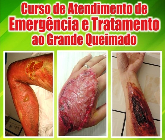 Curso de emergência e tratamento à queimaduras na escola do SINDSAÚDE