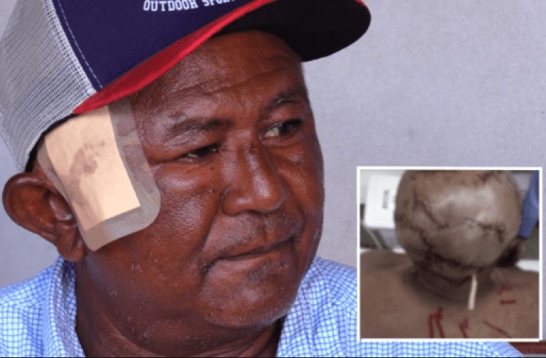 SOBREVIVEU: Indígena atacado por onça leva mais de 150 pontos na cabeça e nas costas