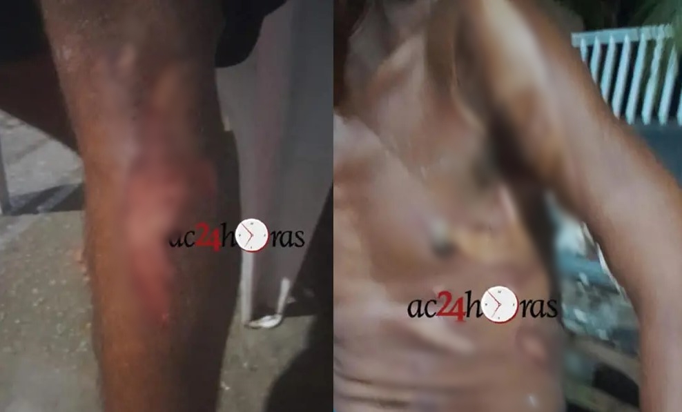 DESUMANO: Morador de rua é queimado com ácido enquanto dormia