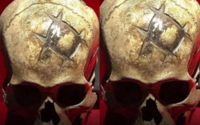 PRECISÃO MÉDICA: Crânio com placa de ouro revela cirurgia cerebral Inca de 1.600 anos
