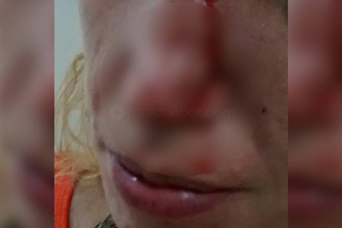 ABSURDO: Esposa tem o nariz fraturado na porrada pelo marido embriagado