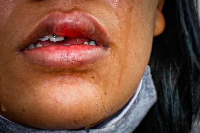 SOCOS NO ROSTO: Mulher tem dente quebrado ao ser espancada pelo marido 
