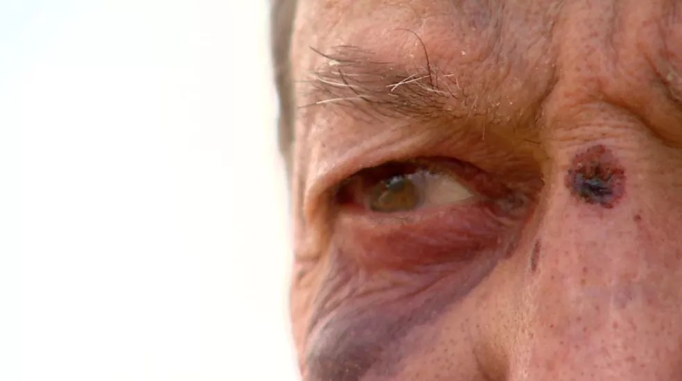 ACUSADO PRESO: Idoso de 80 anos com deficiência visual é espancado a capacetadas 