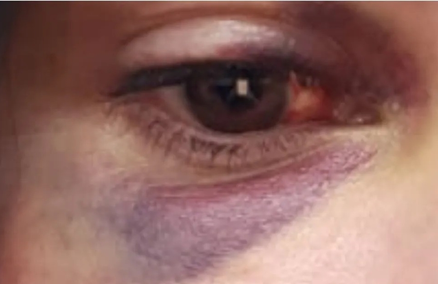 MARIDO VIOLENTO: Jovem com medida protetiva é agredida com socos no olho