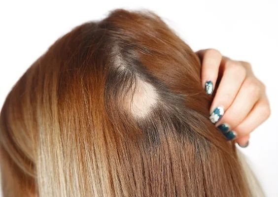 SAÚDE E BEM ESTAR: Saiba mais sobre Alopecia suas causas e tratamentos