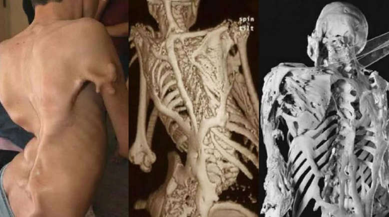 FIBRODISPLASIA: Essa doença rara transforma as pessoas em 'estátuas'; conheça-a 