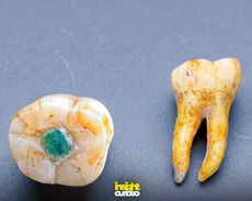 CIMENTO ANTIBIÓTICO: Dentistas maias perfuravam e encaixavam jade nos dentes há 1.000 anos 