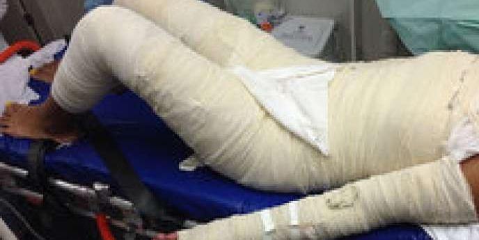 GRAVÍSSIMO: Funcionária da Emater é internada com 70% do corpo queimado; ex-marido fugiu