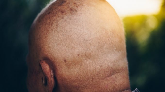 CORRENTE DE SOLIDARIEDADE: Morador de Cerejeiras busca apoio para o tratamento contra tumor na cabeça