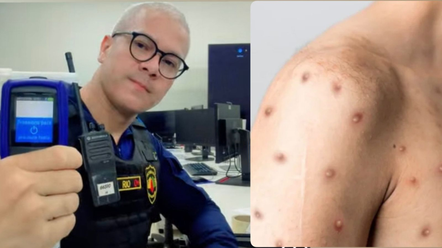 PRECAUÇÃO: Detran cancela ações da Lei Seca após servidor contaminar com o vírus Mpox