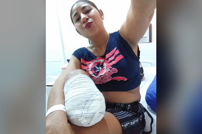ACIDENTE: Após cirurgias, mulher tem perna amputada e necessita custear despesas