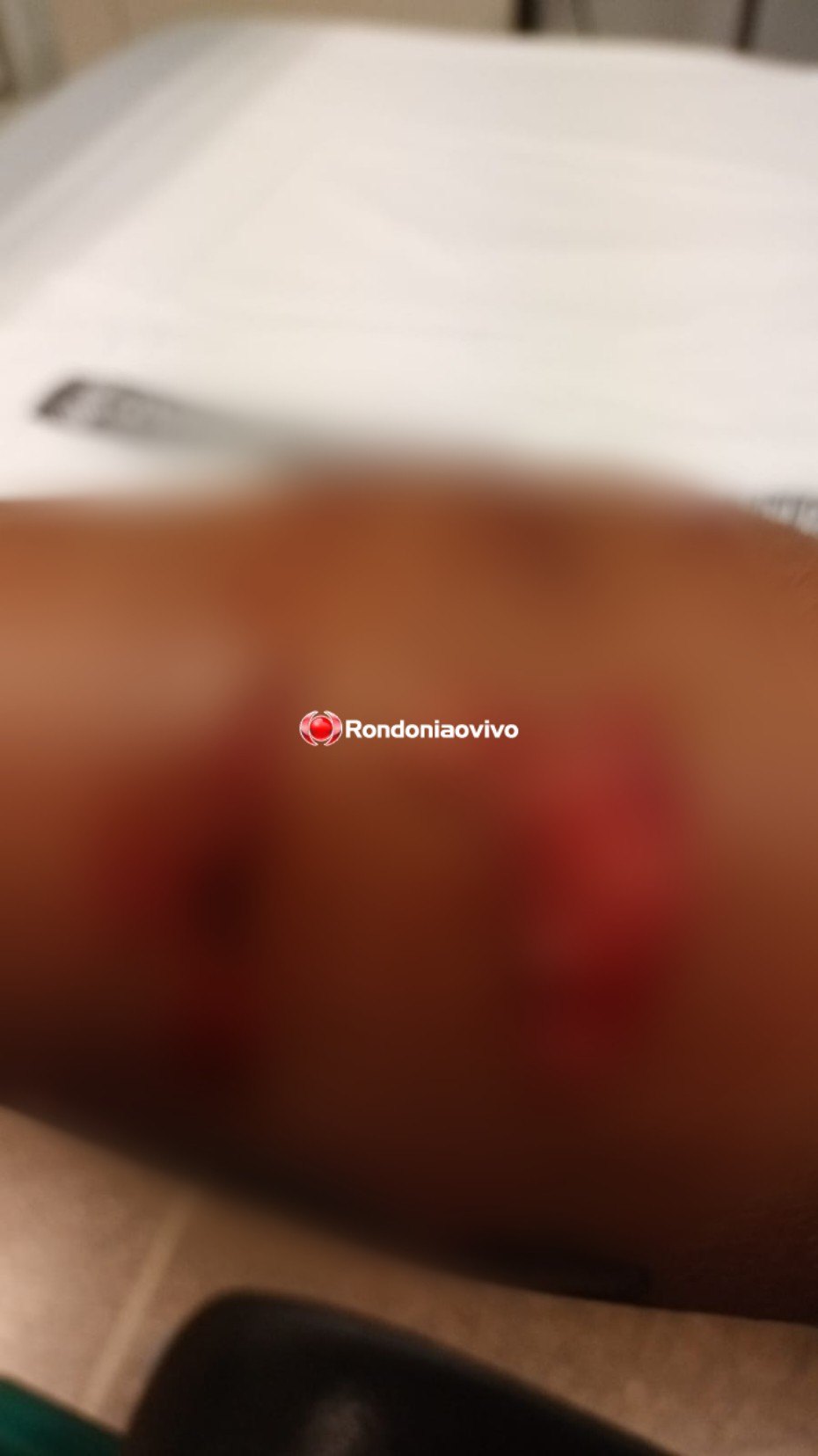 FEROZES: Rondoniense sofre ataque de cães pitbull na Espanha e tem braço dilacerado