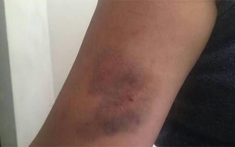 LESIONADA: Tio é preso acusado de agredir sobrinha durante discussão