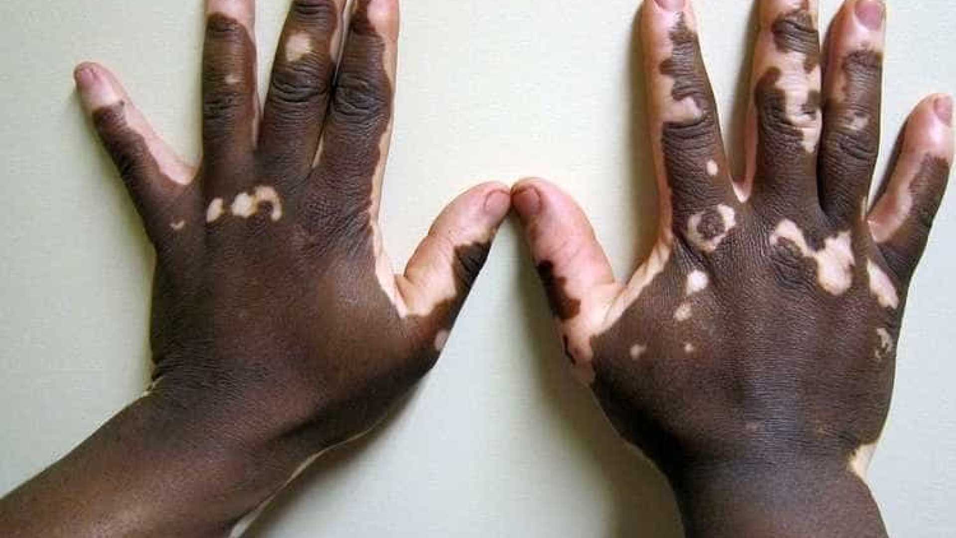 Vitiligo: saiba o que é a doença que causa manchas brancas na pele ...