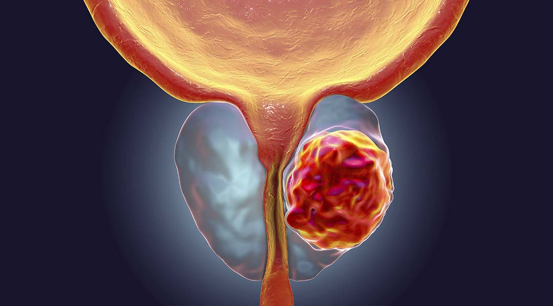 ESPERANÇA: Câncer de próstata tem novo tratamento com radioterapia reduzida