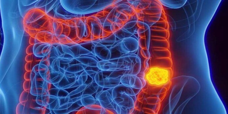 PÓLIPOS: Câncer de intestino é mais comum do que se imagina, veja sintomas